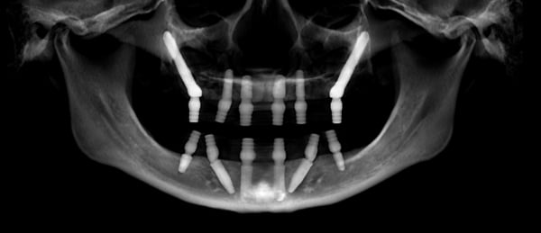 zygomatic implants xray