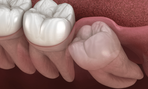 impacted wisdom tooth extraction